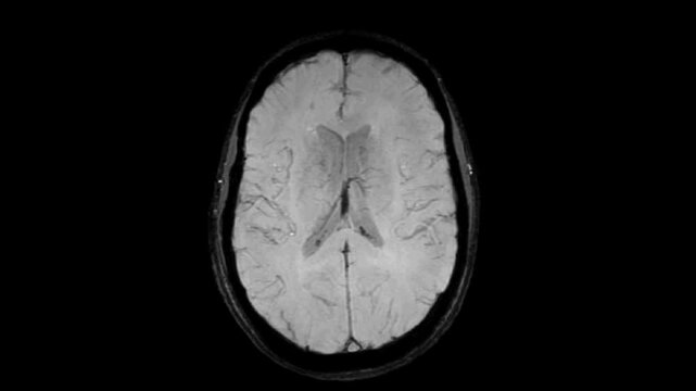 MRI examination of the brain. Minimum intensity projection (MinIP).
