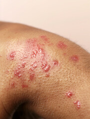 Fototapeta premium Close-up of inflamed skin on the arm due to dermatitis, with visible red patches and dry texture
