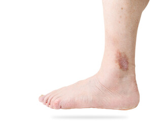 Atopic dermatitis (AD), also known as atopic eczema on leg isolated on white background.