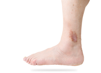 Atopic dermatitis (AD), also known as atopic eczema on leg isolated on white background.