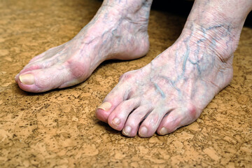 Painful varicose veins  on the legs, lower limbs and feet of an elderly woman.