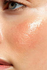 Fototapeta premium Closeup of female cheek with visible signs of rosacea. Red flushing cheeks