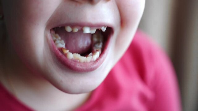 Girl opens mouth wide, shows crooked teeth with cavities. Decayed teeth visible on upper, lower jaw. Tongue is slightly curled. Dental health issues. Poor oral hygiene. Pediatric dentistry problem