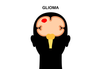 Glioma brain cancer