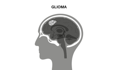 Glioma brain cancer