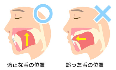 正しいミューイングの方法　適正な舌の位置と誤った舌の位置 © koti