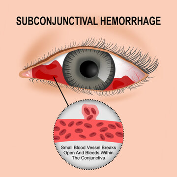 Subconjunctival Hemorrhage, Burst Blood Vessel in Your Eye Illustration