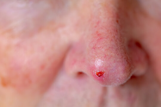 Health care concept, Selective focus of european man with red spot on the nose, Wound on tip of nose, Basal-cell carcinoma (BCC) also known as basal-cell cancer is the most common type of skin cancer.