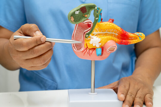 Pancreatitis, pancreatic cancer, Asian doctor with pancreas, gallbladder and bile duct human anatomy model at hospital.