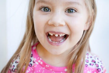 Close-up portrait of a cute Caucasian preschool girl with a loose tooth. Toothless smile. Losing...