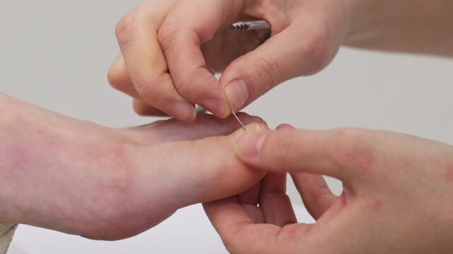 The podiatrist screws a corrective brace around the deformed ingrown toenail of the patient using pedicure forceps in the office during the procedure. Toenail Treatment