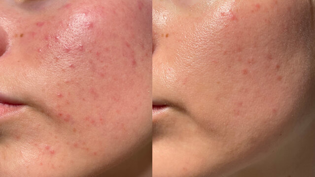 Comparison image of a female face before and after skincare. Visible improvement in pore appearance, acne reduction, and skin glow. Ideal for beauty and dermatology concepts.