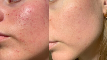 Macro photo of big pore on oily facial skin type. Skin with enlarged pores. Care for problem skin....