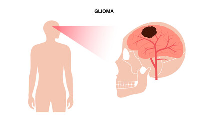 Glioma brain cancer