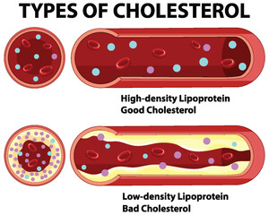 Understanding Types of Cholesterol