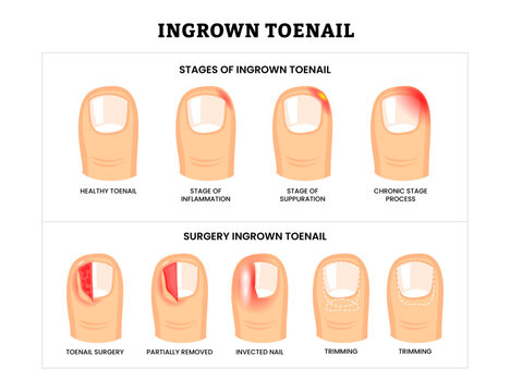 Set different types of ingrown toenail collection with ingrown toenail stages and surgery infographic, partially removed nail , foot disease, infected nail and trimming, isolated on white background.