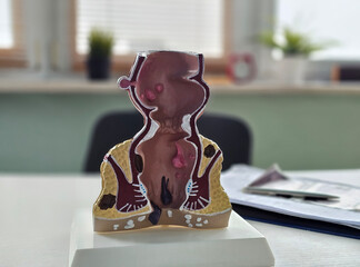 Artificial model of rectum with pathologies pointing pen to problems and explains diseases of...
