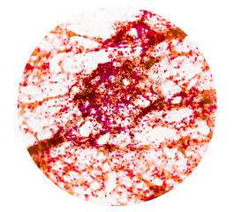 Malignant cells, bronchoalveolar lavage (BAL) adenocarcinoma. Microscopic show cellular material...