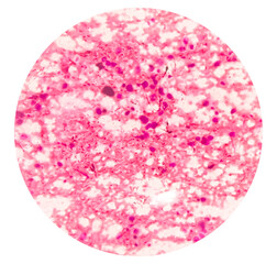 Photomicrograph of Osteolytic lesion of left proximal radium, Positive for malignant cell. small blue round cell tumor, ewing's sarcoma, PNET, metastatic carcinoma