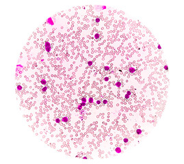 Leukemia, blood cells, blast cells and immatured leukocytic cells in chronic myelomonocytic leukemia, 1000x