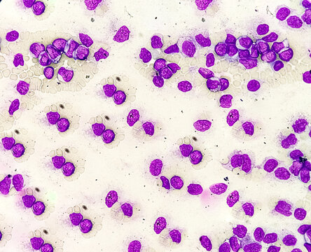 Acute myeloid leukemia (AML) is a type of blood cancer. Microscopic examination of blasts or leukemia cells in blood smear of human. Bone marrow study.