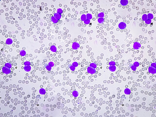 Acute myeloid leukemia (AML) is a type of blood cancer. Microscopic examination of blasts or...