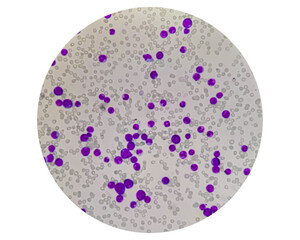 Acute leukemia, ALL (Acute lymphoblastic leukemia), peripheral blood smear, Under 100x light microscope to diagnosis of Acute leukemia.