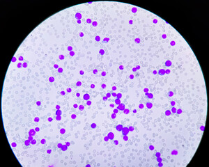 Acute leukemia, ALL (Acute lymphoblastic leukemia), peripheral blood smear, Under 100x light...