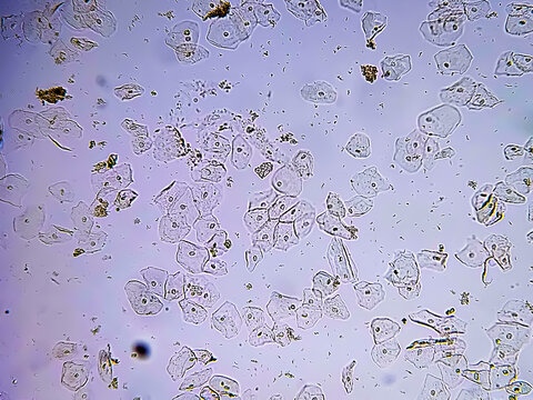 Epithelial cells with bacteria in patient urine (urinary tract infections). Analyze by microscope. Contrast adjustment.