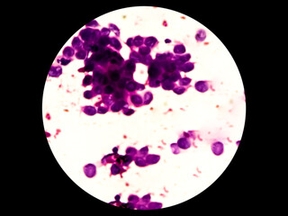 Fine needle aspirate cytology, FNAC of metastatic melanoma. It's large malignant cells.  In the center of this photomicrograph is an "intranuclear inclusion" a feature often associated with melanomas.