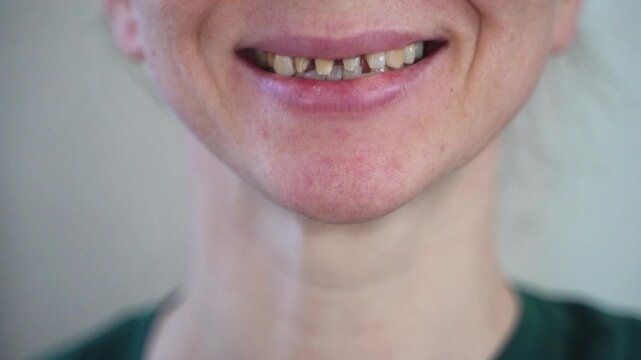 The lower half of a woman's face smiles with bad teeth and, embarrassed by her teeth, covers her smile with her hand