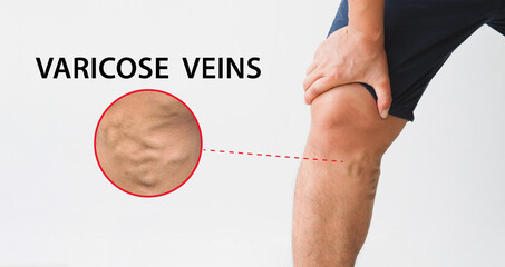Man leg with varicose veins on white background.