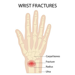 Fototapeta premium Anatomy of the hand radial dislocation aseptic necrosis displacement fracture painful fall