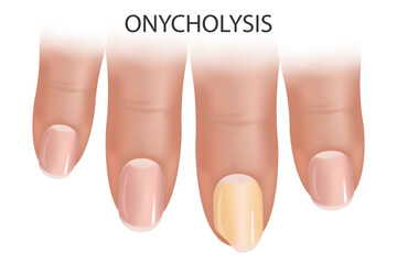 Onycholysis. Comparison and difference between healthy nail and nail plate separation. Nail health