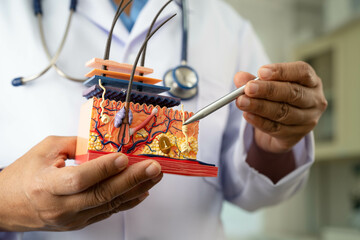 Hair transplant, Asian dermatologist doctor holding skin structure anatomy model for treatment in hospital.