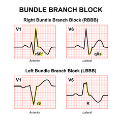Bundle Branch Block | LBBB, RBBB Illustration