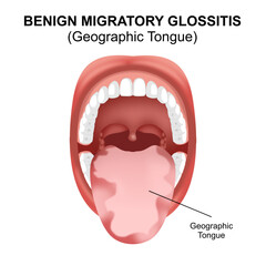 Benign Migratory Glossitis (Geographic tongue)