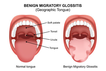 Benign Migratory Glossitis (Geographic tongue)