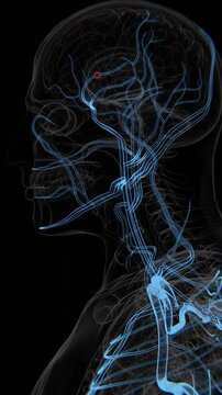 Fusiform Aneurysms in Vertical HQ Video | Cerebral Aneurysms Vertical HQ Video | Brain Stroke