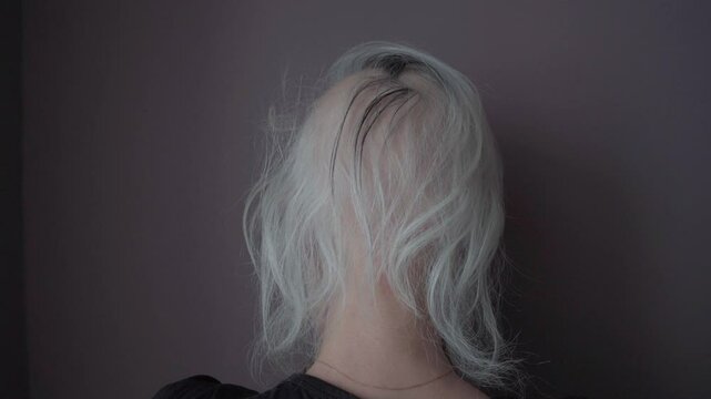 Real alopecia areata in a young girl. A bald head in a person. Diffuse alopecia. Androgenic alopecia. Hair loss. Bald spots on the head. Trichology
