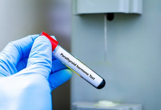Blood sample tube for parathyroid hormone test analysis.