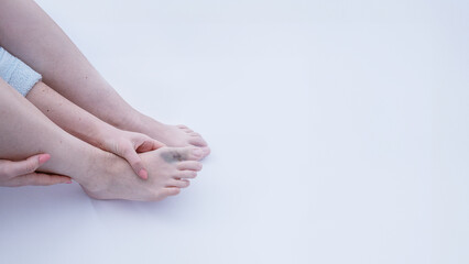 woman sprained her leg. trauma in everyday life. female leg with bruise close-up on the white...