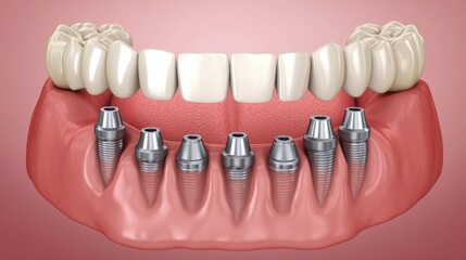 Dental Implants Full Arch Restoration