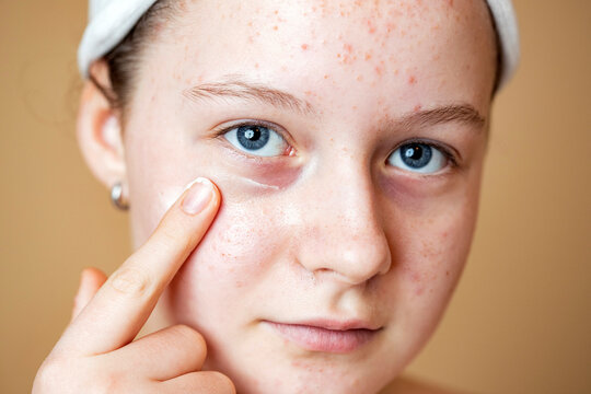 Problematic skin. Acne and red festering pimples on the face of a young girl using cream.