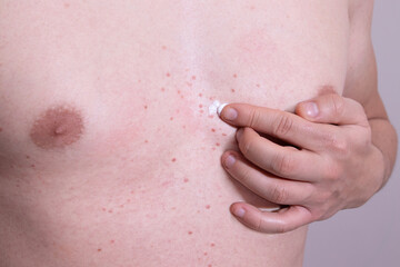 Fototapeta premium Man applying medicated cream to red skin rashes on his chest. Dermatological treatment. Skin rashes treatment