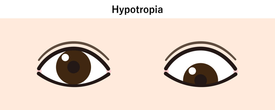 下斜視のイラスト（Strabismus/Hypotropia）