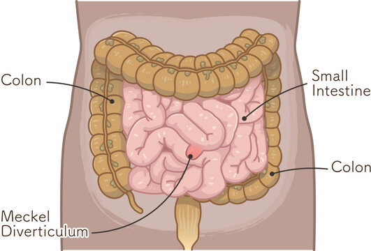 Diverticulum・ meckel diverticulum・small intestine・colon・illustration