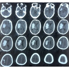 CT scan of brain, Intraventricular hemangioma with adjoining periventricular seepages and herniation.