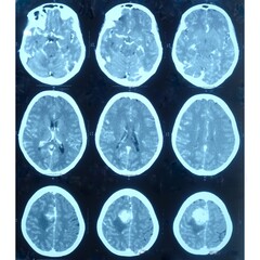 CT scan of brain, Intraventricular hemangioma with adjoining periventricular seepages and...