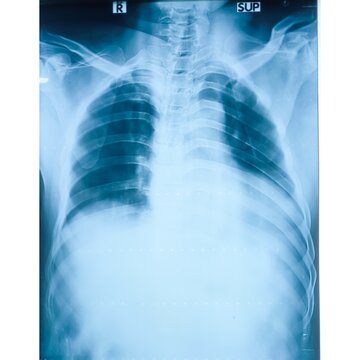 Chest x-ray image demonstrated heart, lungs, ribs, bones and muscles. Xray shown cardiomegaly in congestive heart failure.